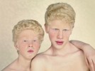 10 Interesting Albinism Facts