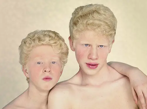 Albinism Facts