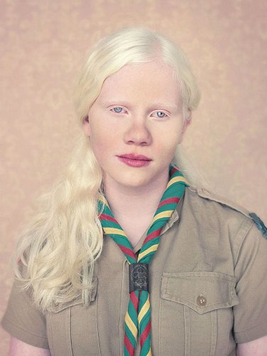 Albinism in a Girl