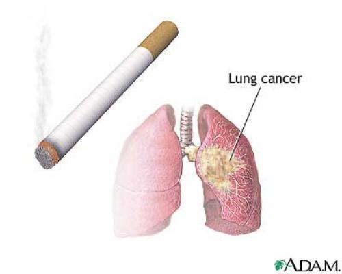 Lung Cancer Facts