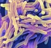 10 Interesting Tuberculosis Facts