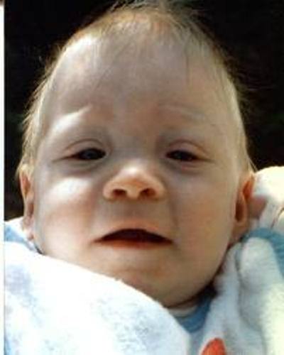 baby with down syndrome