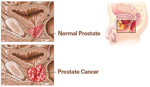 Prostate Cancer Facts