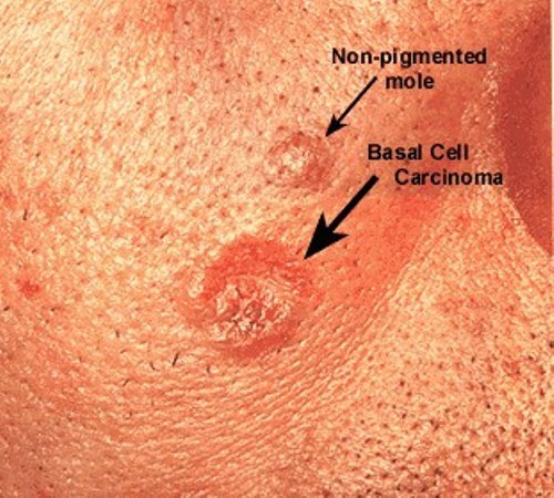 Basal Cell skin cancer