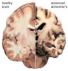 10 Interesting Alzheimer Disease Facts