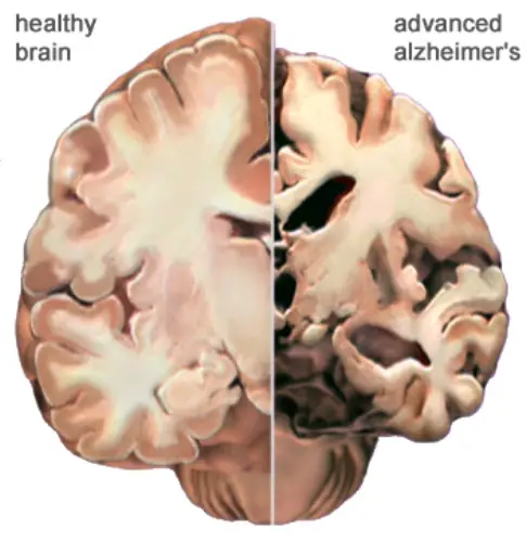 alzheimer brain