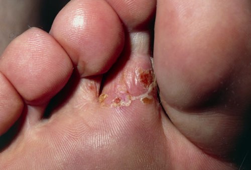 Athlete's Foot Disease