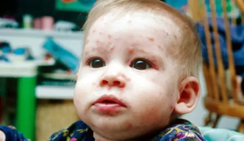 Chickenpox in baby