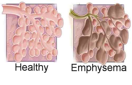 Emphysema Pic
