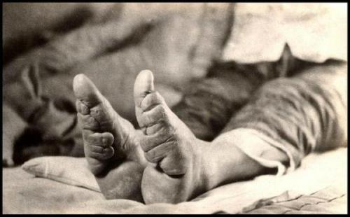 10 Interesting Foot Binding Facts - My Interesting Facts