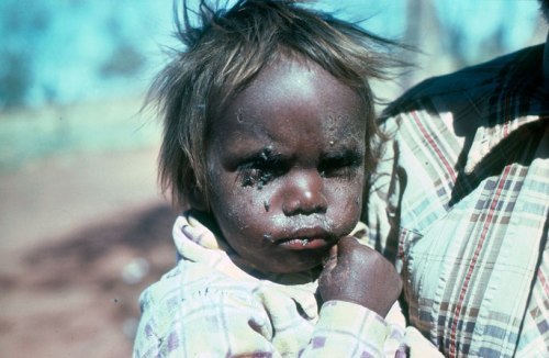 trachoma