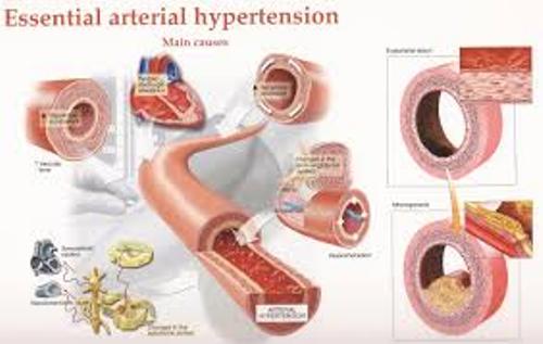 Hypertension Facts