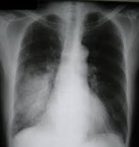 pneumonia Pic