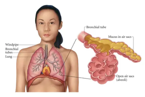 pneumonia image