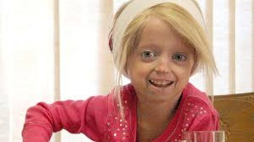 Progeria Child