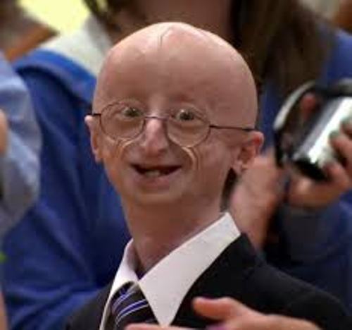 Progeria  Pictures