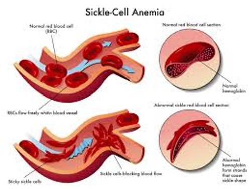 sickle cell anemia Facts