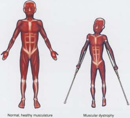 facts about muscular dystrophy